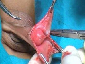 Male penis enlargement surgery
