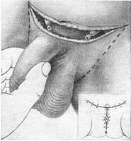 Surgical extension of the penis by pulling out the hidden part